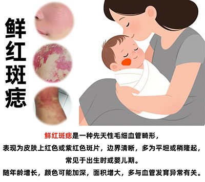 鲜红斑痣治疗医院南京哪家好？怎么选不踩坑？