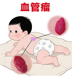 血管瘤遗传吗？南京哪家医院治疗血管瘤好？